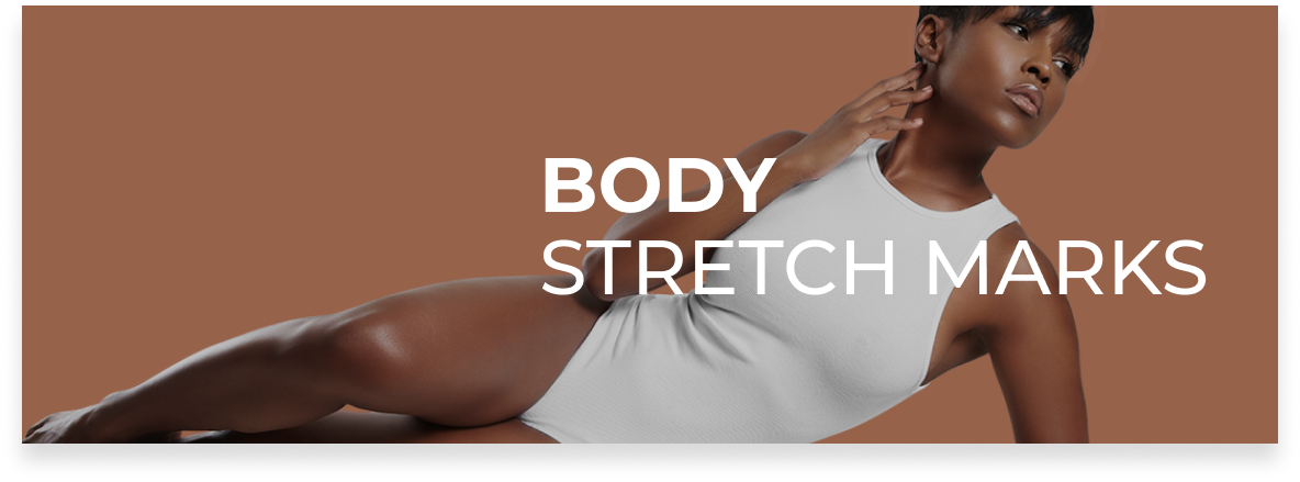 Body strech marks